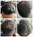 Click image for larger version

Name:	TakenByPatient-12Months2ndHT-2.jpg
Views:	184
Size:	93.9 KB
ID:	500456