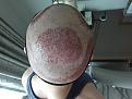 Click image for larger version

Name:	2. after surgery.jpg
Views:	123
Size:	63.4 KB
ID:	501141