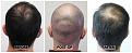 Click image for larger version

Name:	DonorNonshaved-Forum.jpg
Views:	566
Size:	96.2 KB
ID:	502130
