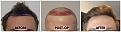 Click image for larger version

Name:	Hairline-Forum.jpg
Views:	255
Size:	99.9 KB
ID:	502136