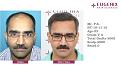 Click image for larger version

Name:	hair-transplant-before-after-1.jpg
Views:	413
Size:	19.5 KB
ID:	502306