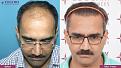 Click image for larger version

Name:	hair-transplant-before-after-2.jpg
Views:	409
Size:	20.1 KB
ID:	502307