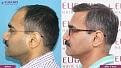 Click image for larger version

Name:	hair-transplant-before-after-3.jpg
Views:	408
Size:	20.4 KB
ID:	502308