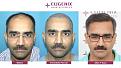 Click image for larger version

Name:	hair-transplant-before-after-7.jpg
Views:	404
Size:	20.1 KB
ID:	502312