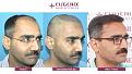 Click image for larger version

Name:	hair-transplant-before-after-9.jpg
Views:	376
Size:	20.7 KB
ID:	502314