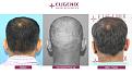 Click image for larger version

Name:	hair-transplant-before-after-10.jpg
Views:	399
Size:	19.4 KB
ID:	502315