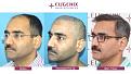 Click image for larger version

Name:	hair-transplant-before-after-11.jpg
Views:	404
Size:	20.5 KB
ID:	502316