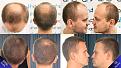 Click image for larger version

Name:	natural-hair-transplant-results.jpg
Views:	2
Size:	53.9 KB
ID:	540477