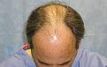 Top of Head and Hair Line before

View his full photoset >> http://www.bernsteinmedical.com/hair-transplant-photos/portraits/patient-fzi/