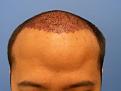 Big lump on my the front of my head, after the procedure this is normal swelling that starts to happen.