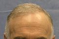 Patient BHZ After 1 Session
 
View his full photoset >> http://www.bernsteinmedical.com/hair-transplant-photos/portraits/patient-bhz/