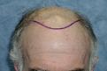 Patient BHZ planned hairline
 
View his full photoset >> http://www.bernsteinmedical.com/hair-transplant-photos/portraits/patient-bhz/