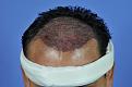 After surgery picture, see the natural path of my hair.