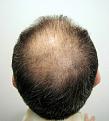 Before hair transplantation