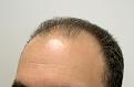 Before hair transplantation