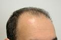 Before hair transplantation