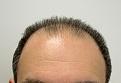 Before hair transplantation