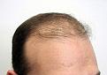 Before hair transplantation