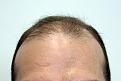 Before hair transplantation