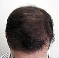 After 3511 follicular units by Dr. Dorin