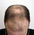 Before hair transplantation