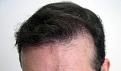 After 3511 follicular units by Dr. Dorin