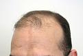 Before hair transplantation
