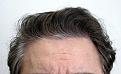 After 1 FUT:  2012 follicular units