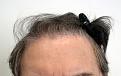 Before hair transplantation