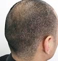 11 days after 1500 FUE