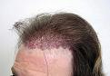 IMMEDIATELY AFTER 1630 FOLLICULAR UNITS PLACED