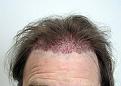 IMMEDIATELY AFTER 1630 FOLLICULAR UNITS PLACED