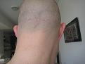 (091212) repaired strip scar December 12, 2009 - at zero setting of electric hair shear - after 3 FUE graft sessions into the scar.  I realize my strip scar will never be perfect but now can I shave my head to the scalp with minimal visibility of the scar.