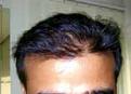 hair transplant after