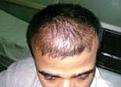 hair transplant before