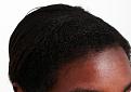After 1 Hairline FUT