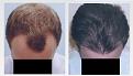 Before and after hair transplant procedure