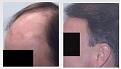 Before and after hair transplant procedure