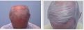 Before and after hair transplant procedure