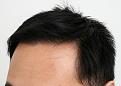 Hairline result after 10 months