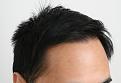 Hairline result after 10 months