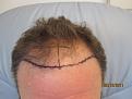 In Chair after marking by doctor