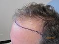 In Chair after marking by doctor