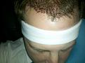 night after surgery