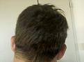 Back of head -1 month