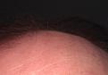Hair peach fuzz growth - Day 5 TRX-2.