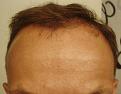 A very little was done to the front where my receding hairline is showing but you would think that 2381 grafts would be able to at least make a significant difference!