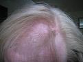 hairloss 063