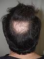 Before hair transplant to crown