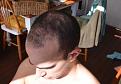 KD lSide2 On Down 15022012
Pre FUE Hair Transplant Dr Woods
www.fuehairtransplanttruth.com
